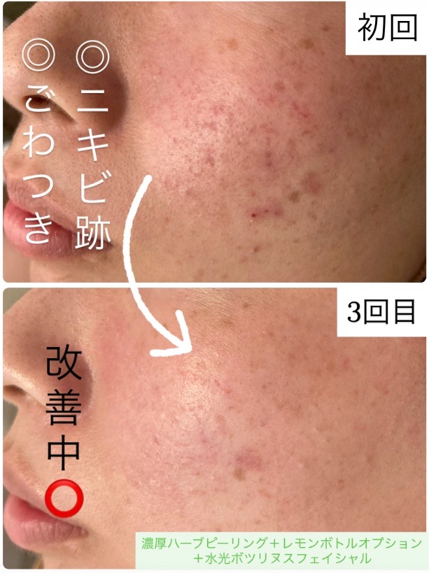 ニキビが出来にくいお肌に変わります♪