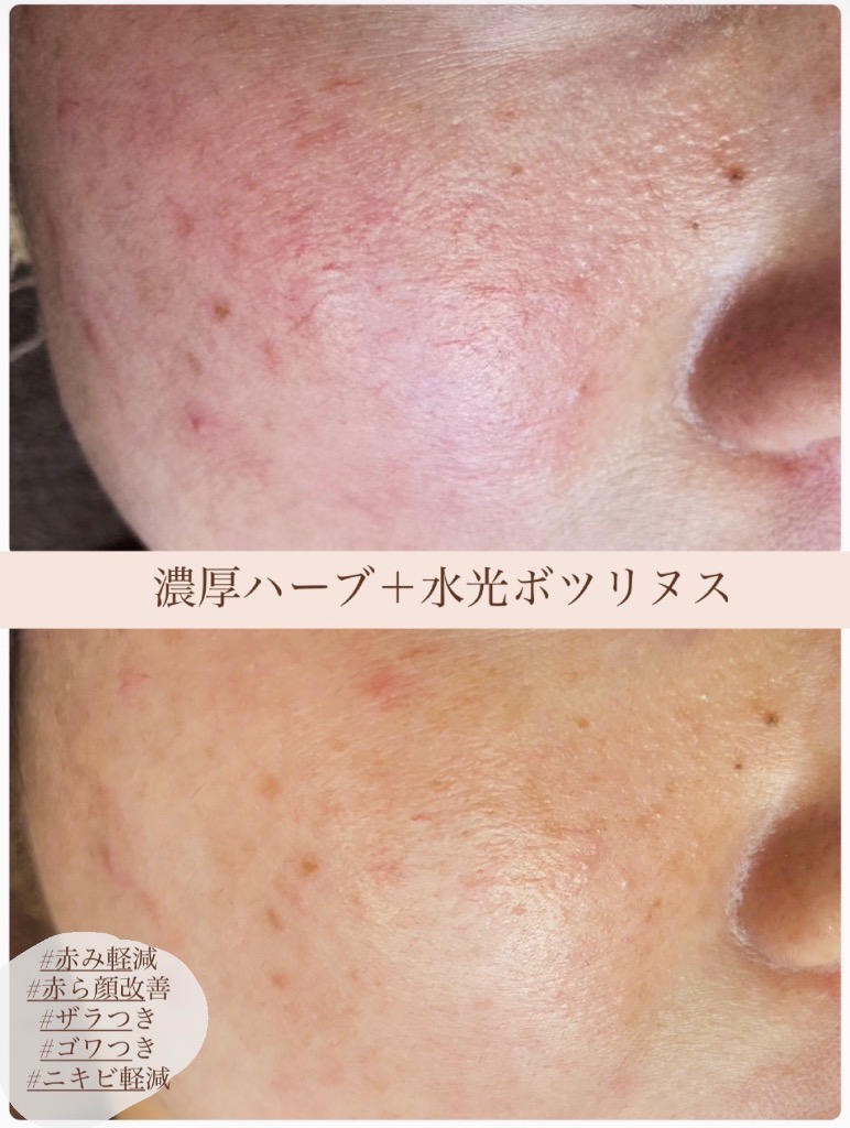  赤ら顔＆ザラつき＆ニキビケア 同時に改善◎