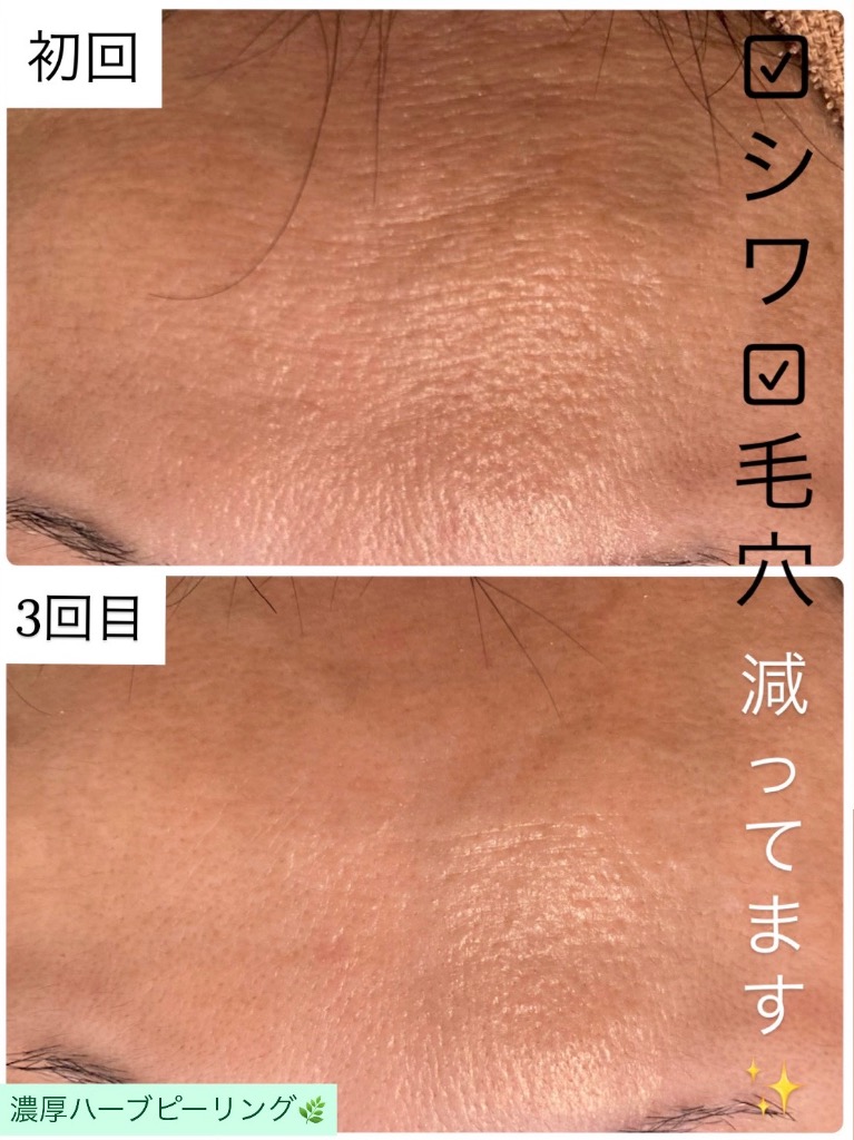 おでこのシワ・毛穴減ってます✨