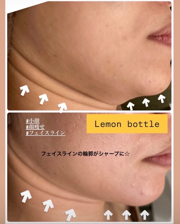 顎下のもたつきが取れてフェイスラインが上がってます✨