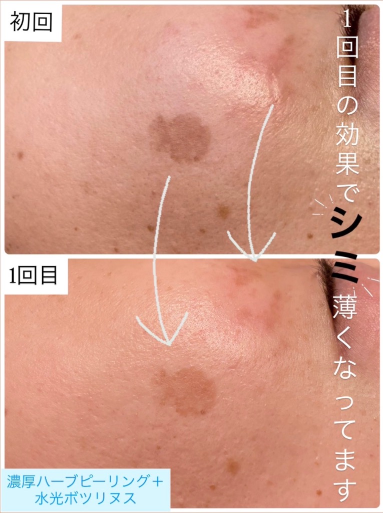 大きなシミも薄くなってます✨