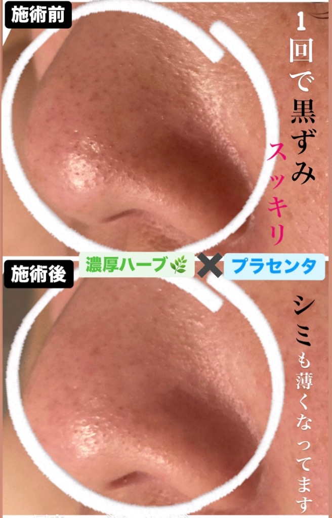 １回で黒ずみスッキリ(^^)