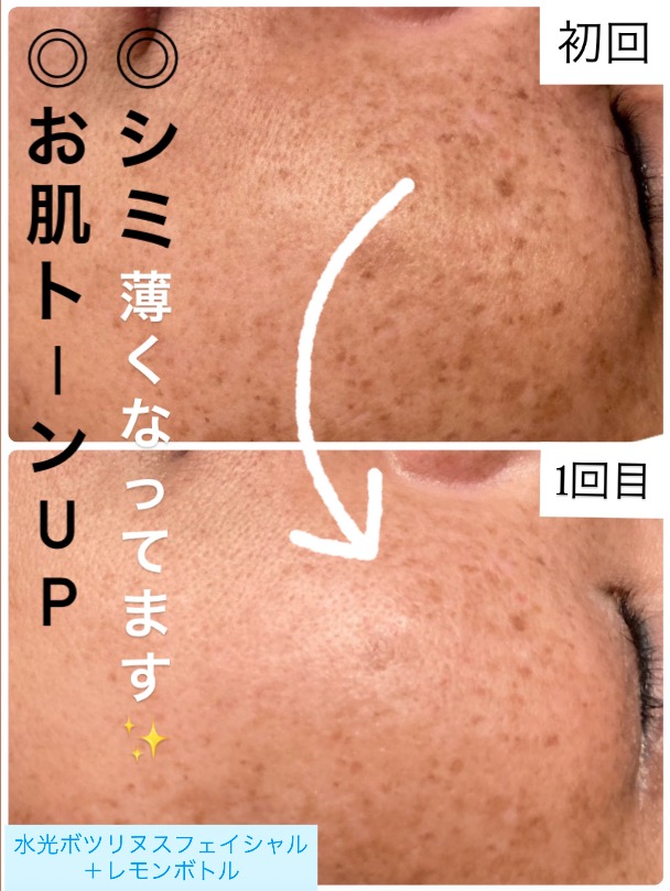 1回目の効果でシミ・クスミが...😳✨
