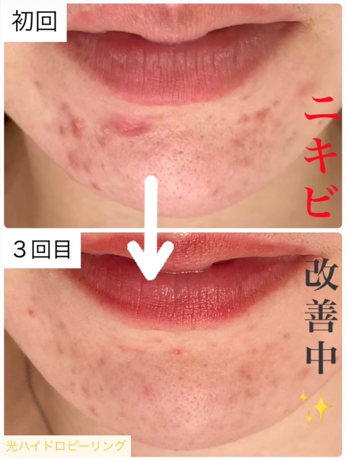 どんなニキビも⭕️