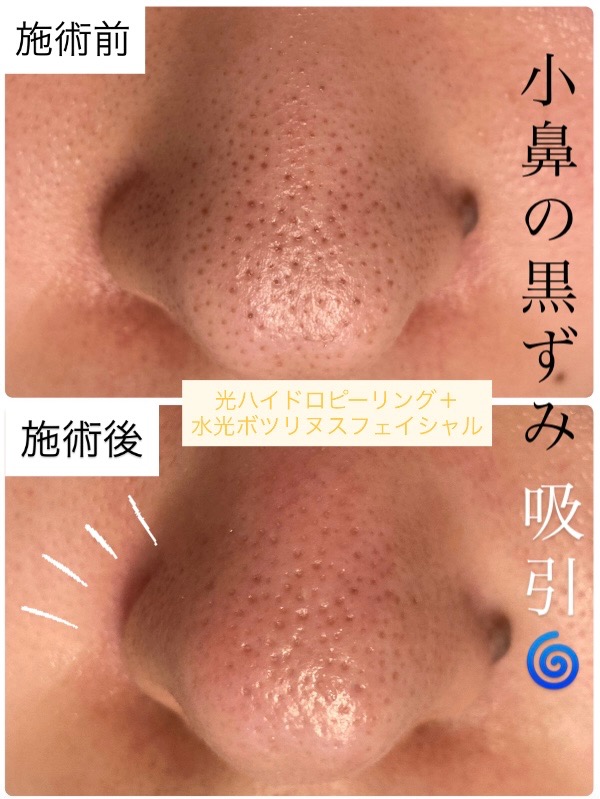頑固な小鼻の角栓もしっかり吸引✨