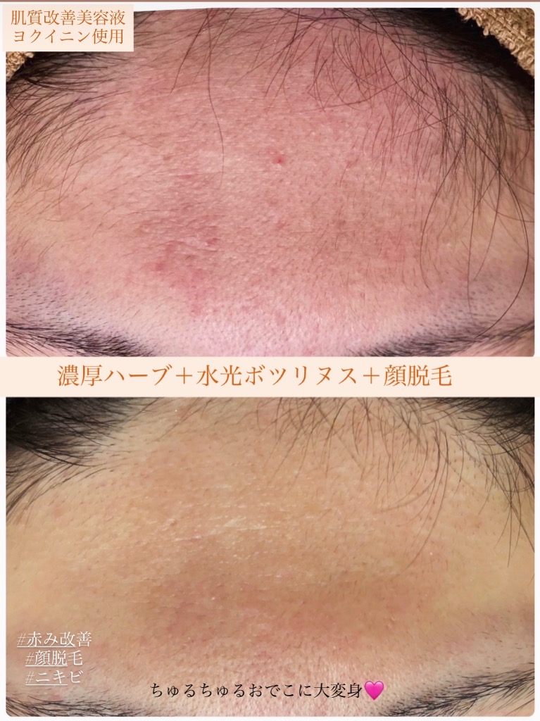 赤みと顔脱毛で同時に改善◎
