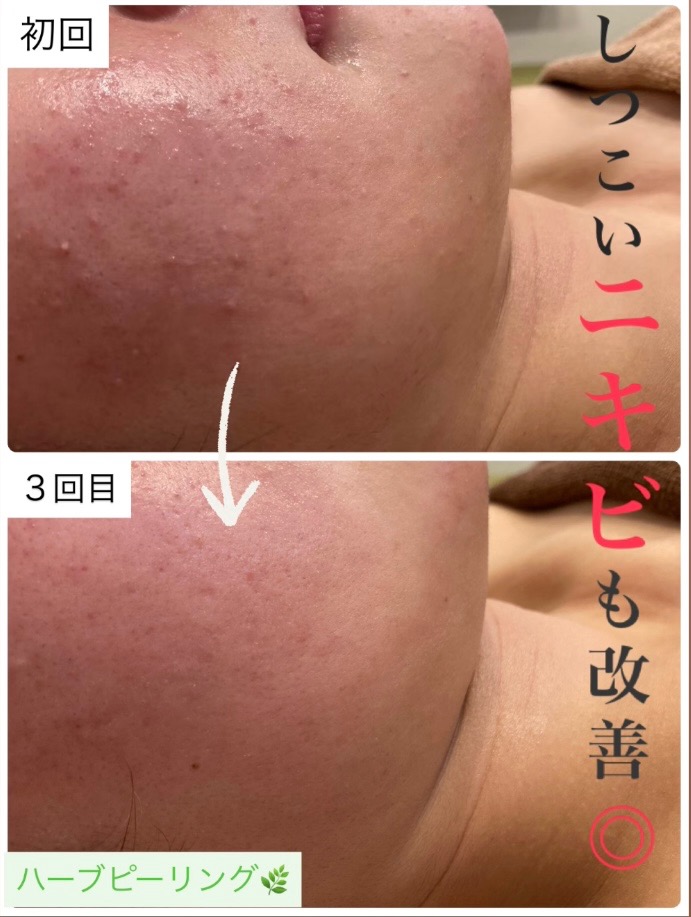 どんなニキビも◎