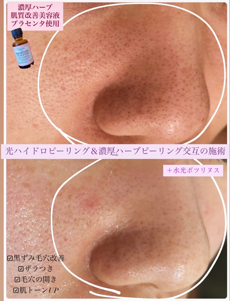 夏の汚れは光ハイドロで根こそぎ洗浄して スッキリツルツル肌に♪