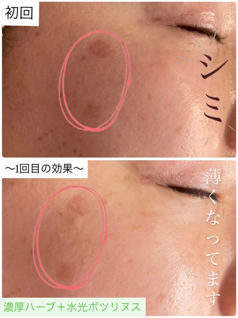 施術１回目の効果でシミが薄くなってます♪