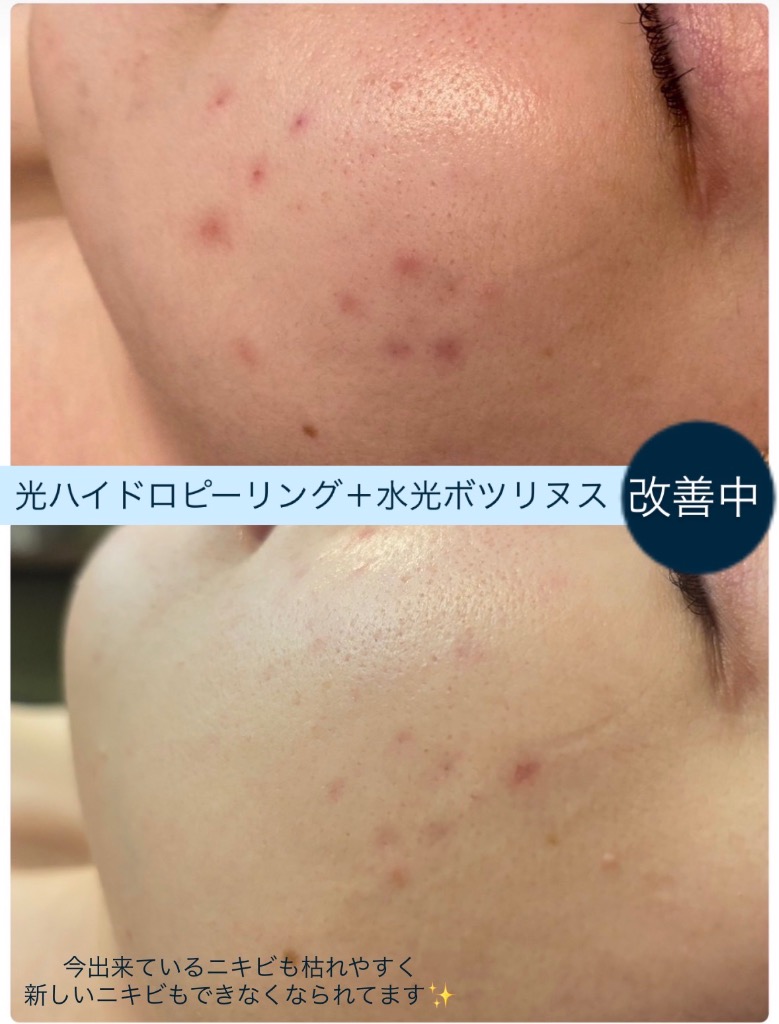 新しいニキビもらできなくなり、あと少しでニキビ跡が改善できそうです◎