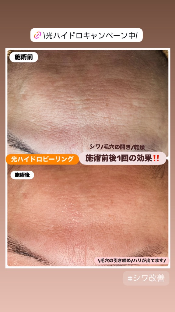 1回で内側からしっかりハリが出ました❣️
