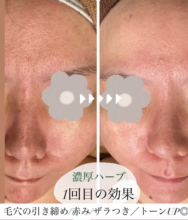 1回の施術でこの効果･:*+.\(( °ω° ))/.:+