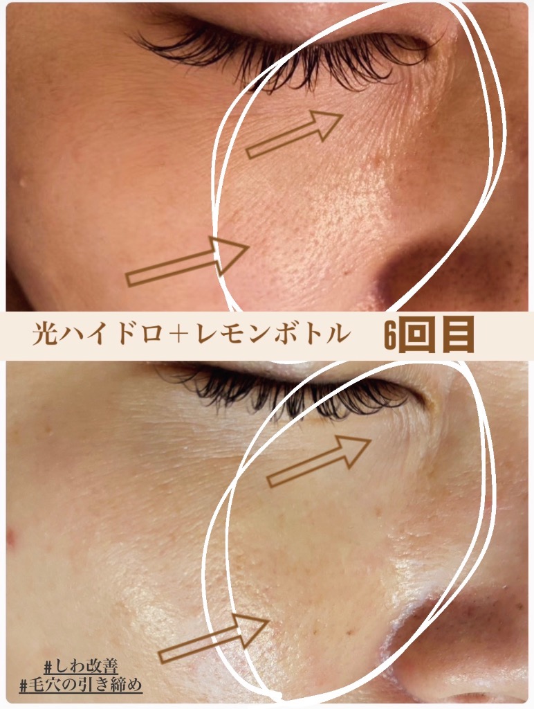 しわと毛穴の同時改善✨