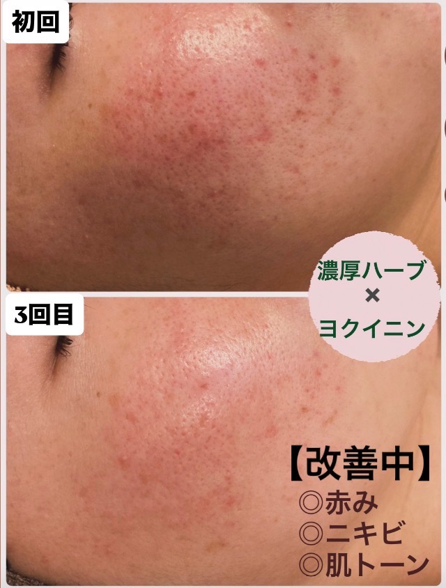 ニキビがどんどん改善されてきてます‼️