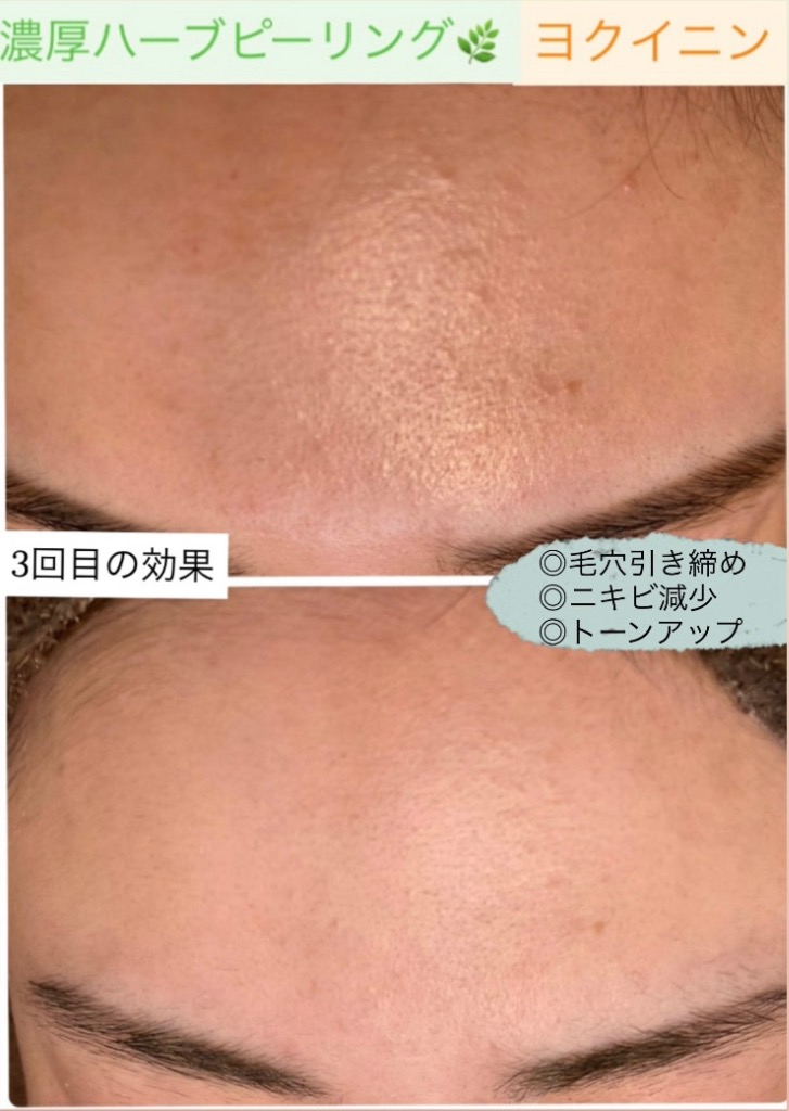毛穴減ってます(^^)