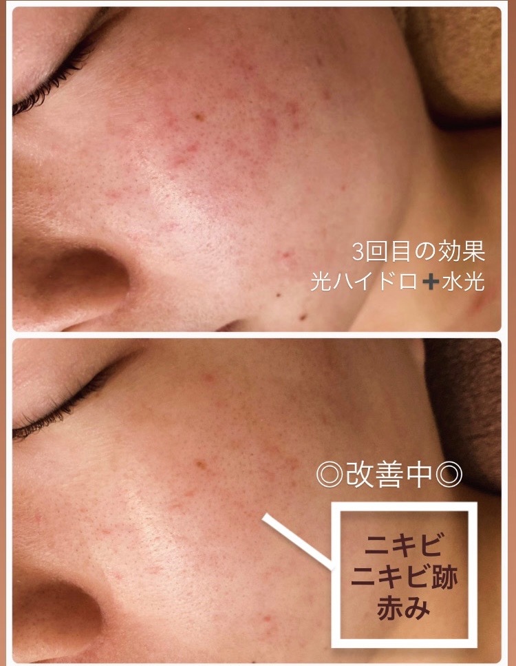 光ハイドロ＋水光ボツリヌス