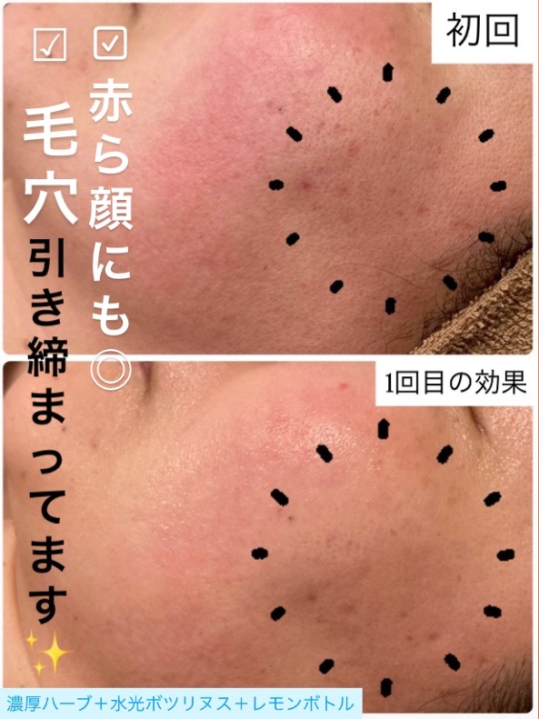 1回目の効果で毛穴引き締ってます✨