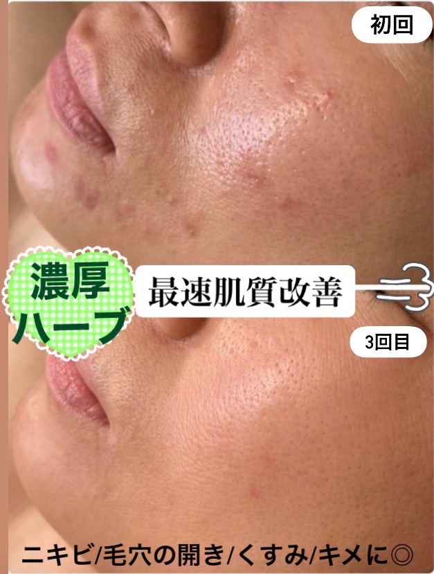 ニキビ肌を早く改善したい方に◎