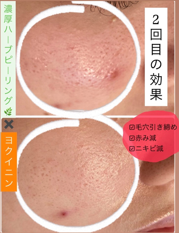 毛穴も赤みも減ってます(^^)