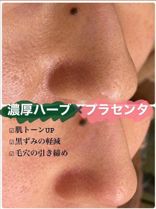 日を追うごとに毛穴も小さくなっていきます✨