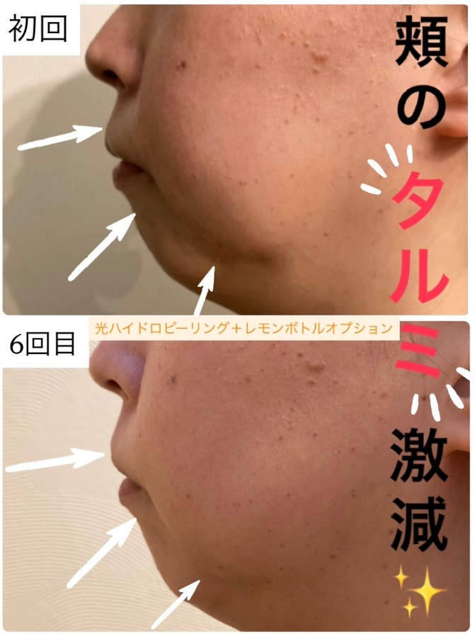 頬のたるみ・頬の脂肪激減！✨