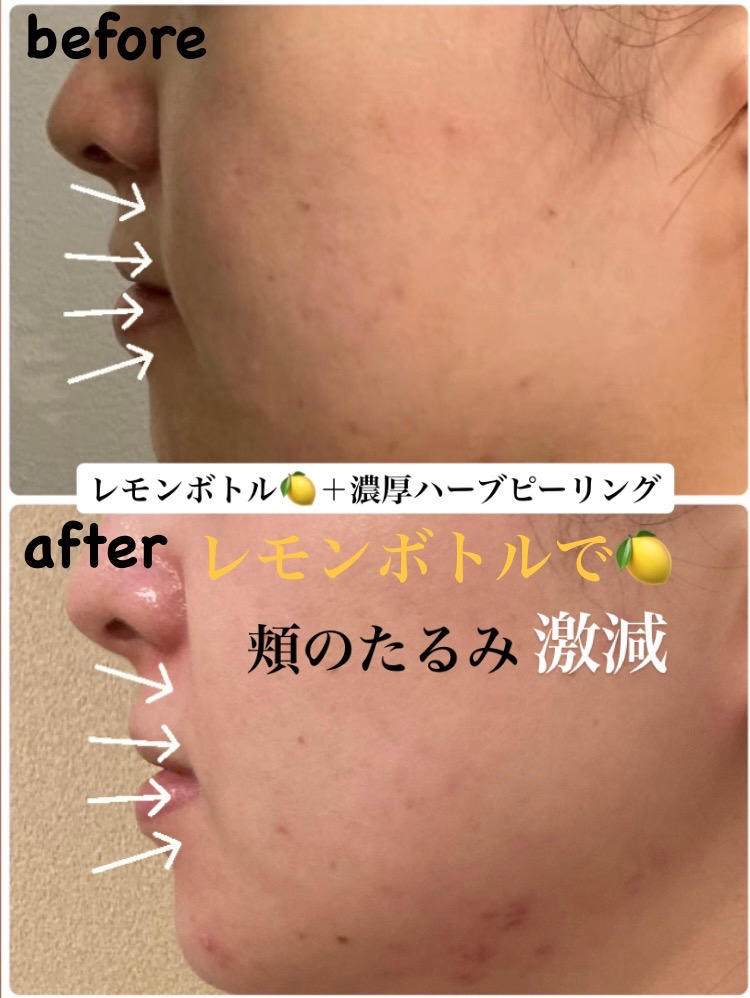 頬の脂肪がスッキリ(^^)