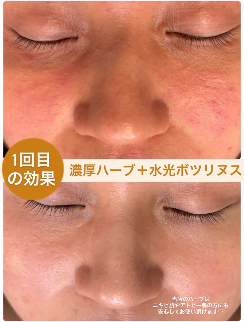 赤みや吹き出物がなかった事に‼️😳