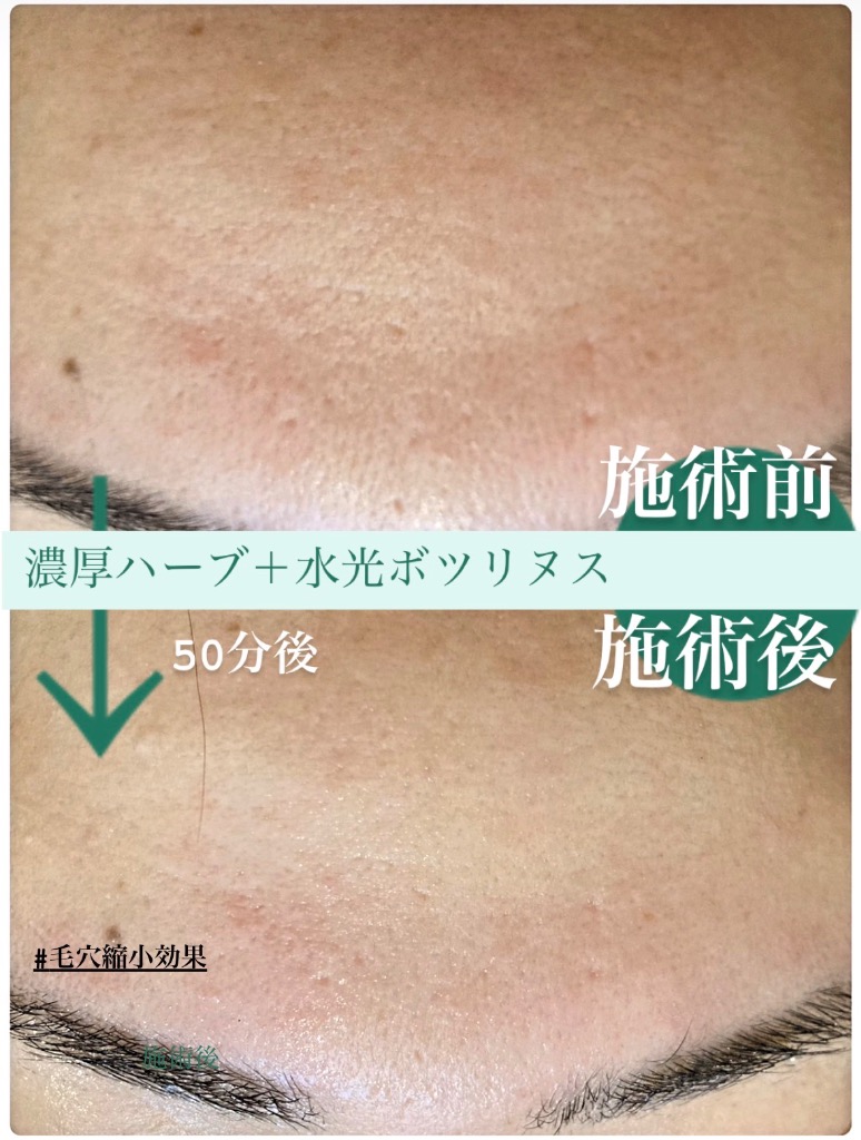 毛穴縮小効果が1回目でしっかり出てます✨