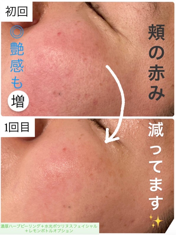 1回目の効果で頬の赤みが減り、お肌が艶々になってます🫧
