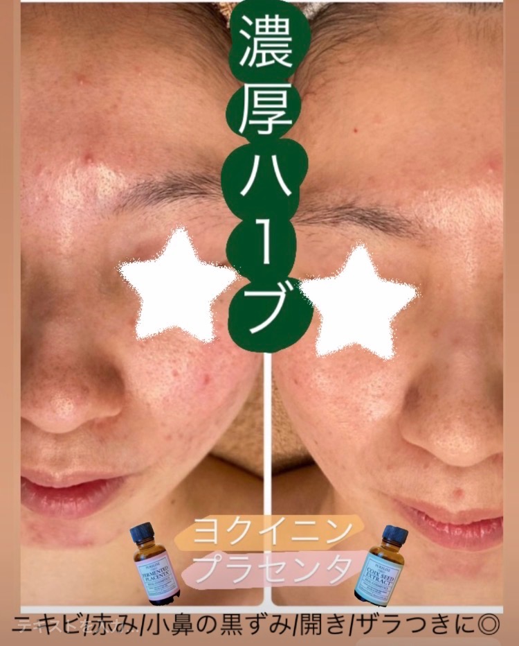 赤みとニキビが減るとお顔の印象が変わります✨