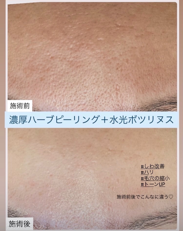 施術前後1回の効果‼️シワ改善と毛穴の縮小効果✨