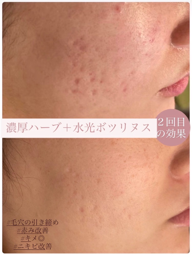 毛穴/ニキビ改善に特化した組み合わせ