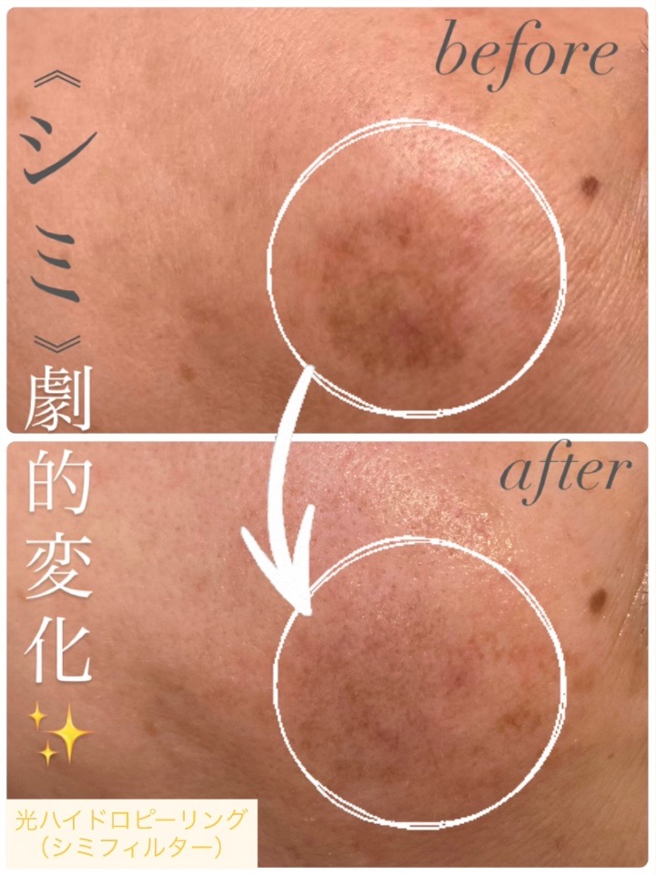 シミ劇的変化！！✨