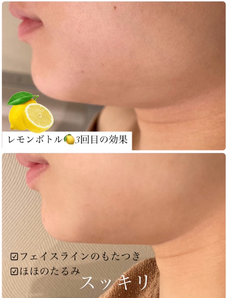 効果実感！頬とフェイスラインスッキリ(^^)