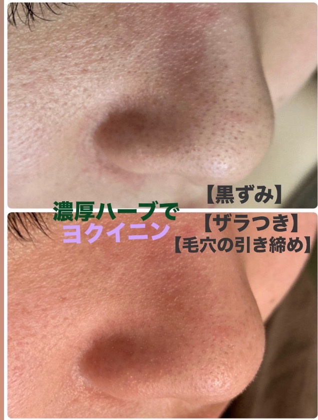 黒ずみやザラつきもスッキリ✨