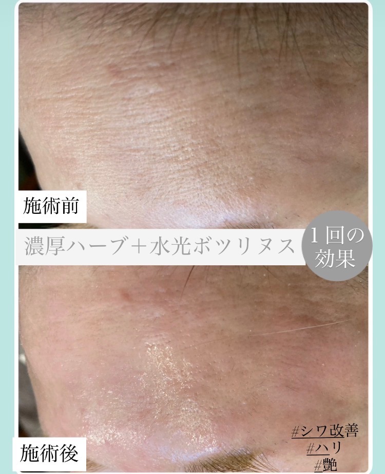 シワ改善/ハリ艶✨