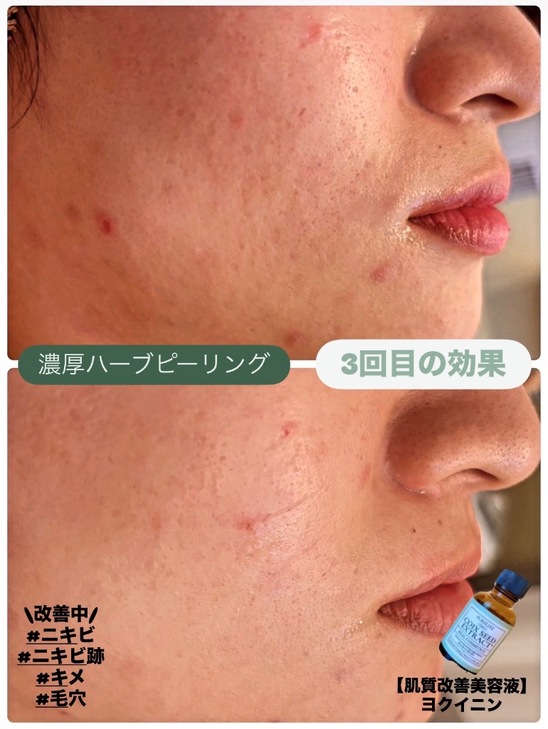 ニキビが枯れて新しいニキビも一気に減少😍