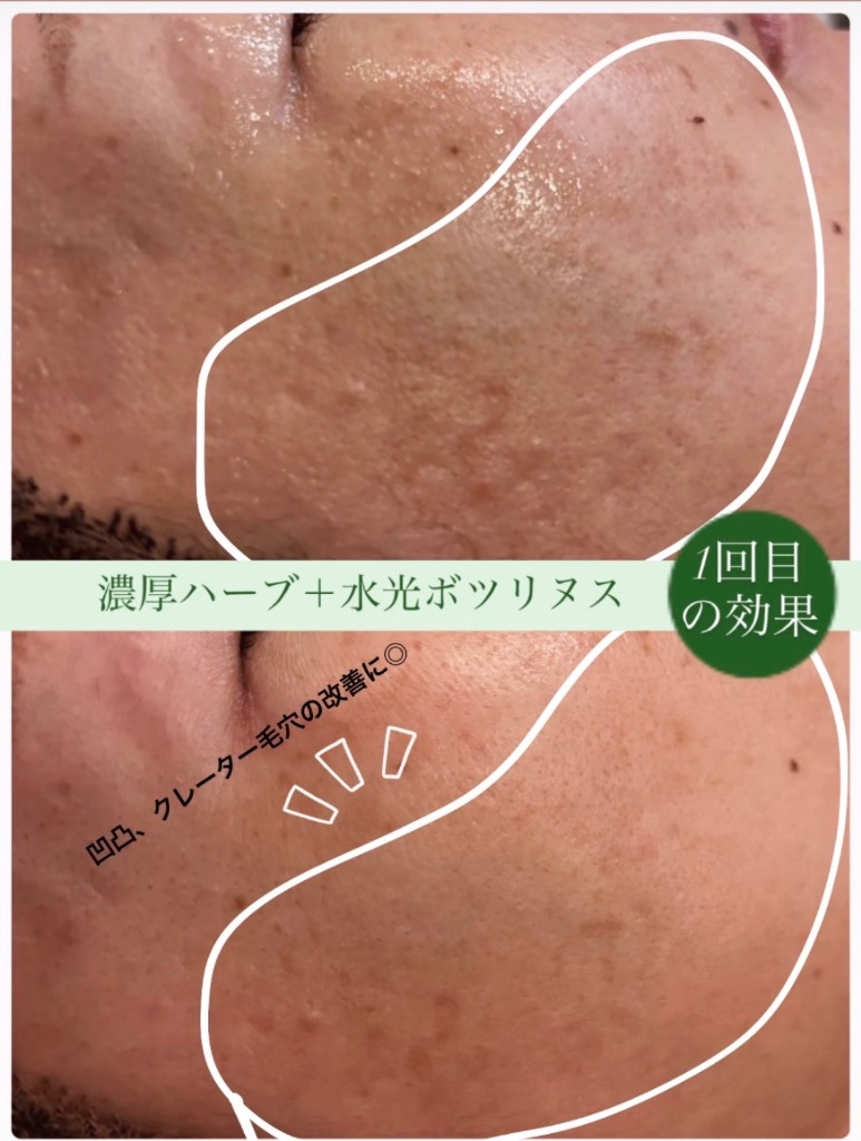 1回で毛穴の凹凸感が目立たなくなってます🤩