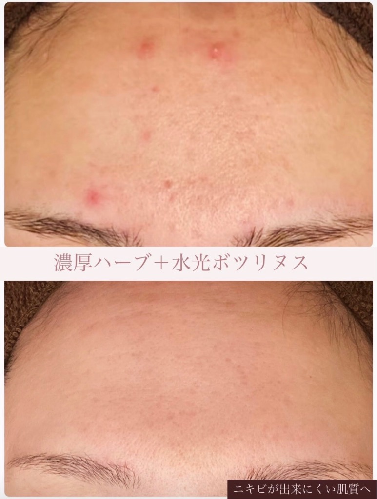 ニキビが出来ない肌質へ