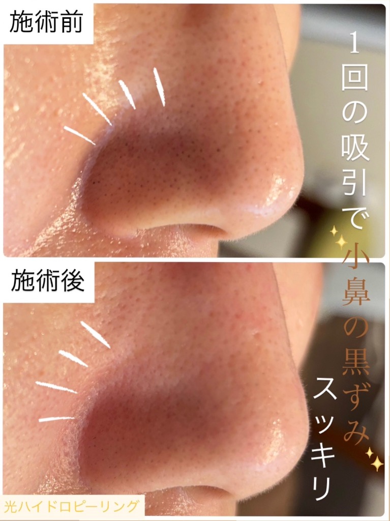 これからの季節にはお勧めな施術''光ハイドロピーリング''