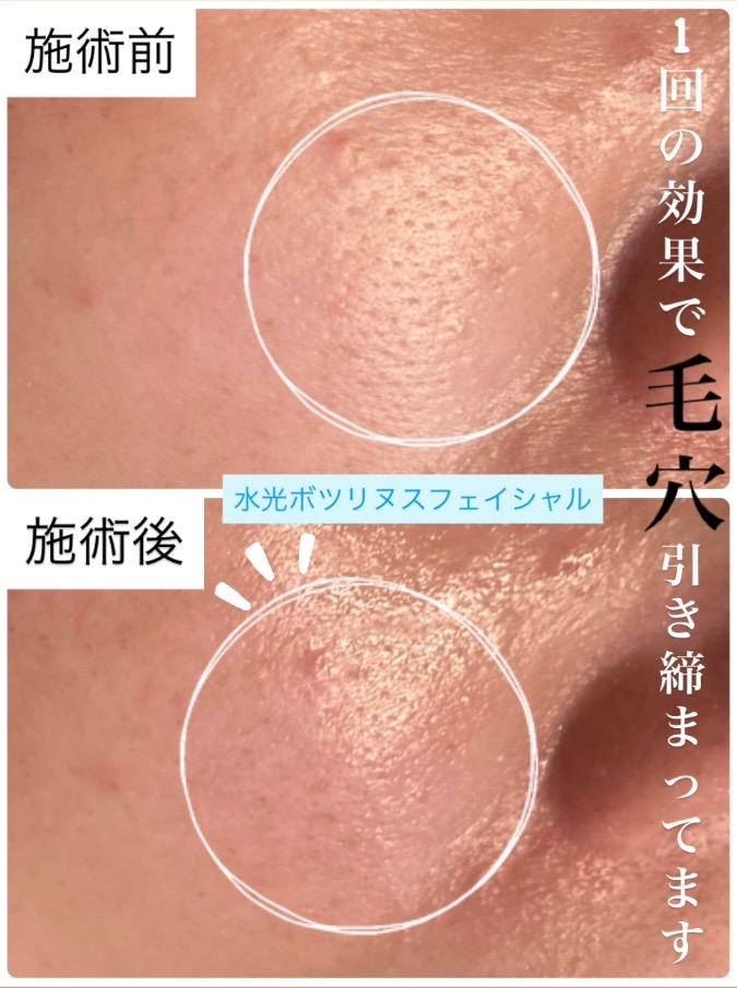 ボニックスの美容液を導入するだけで👀✨