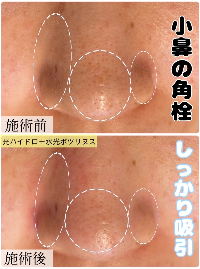 夏は皮脂や汚れが溜まりやすい...。
