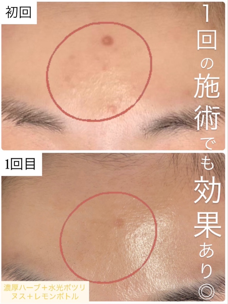 １回目の効果でニキビ跡が薄くなってます✨