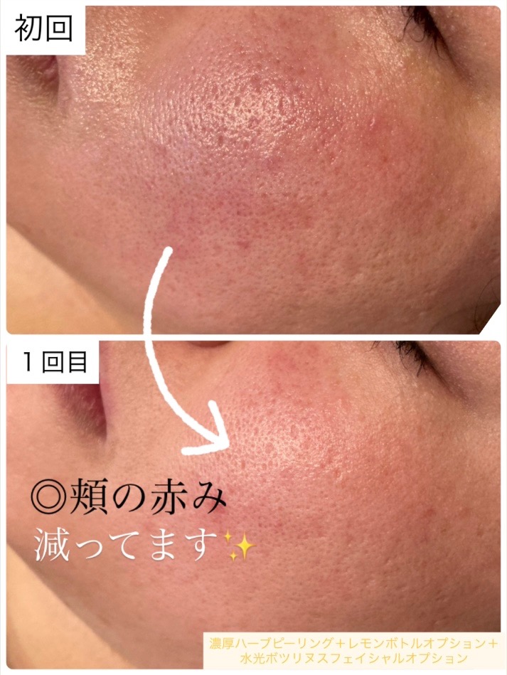 水光ボツリヌス1回目の効果で✨