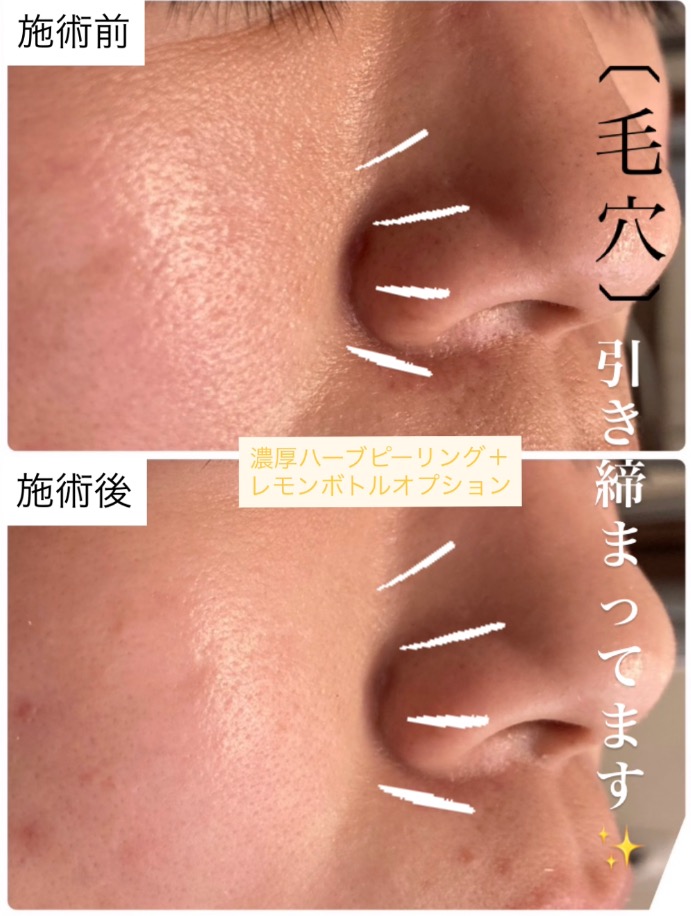 ハーブを10分間擦り込むだけで...!✨