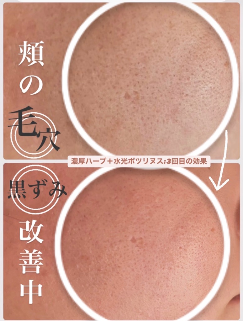 黒ずみが取れて毛穴が引き締まってきてます◎