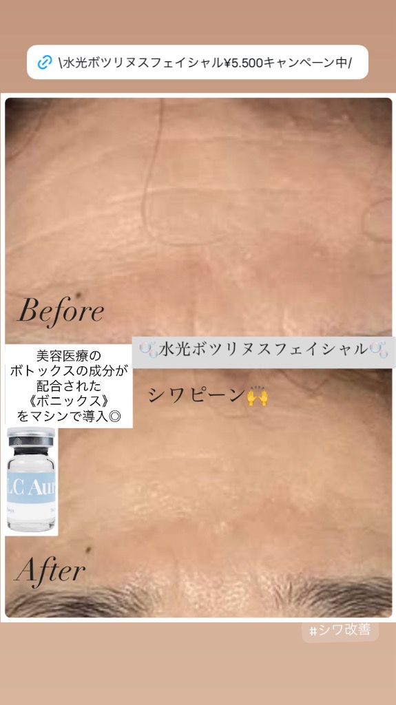 1回目の施術効果💖