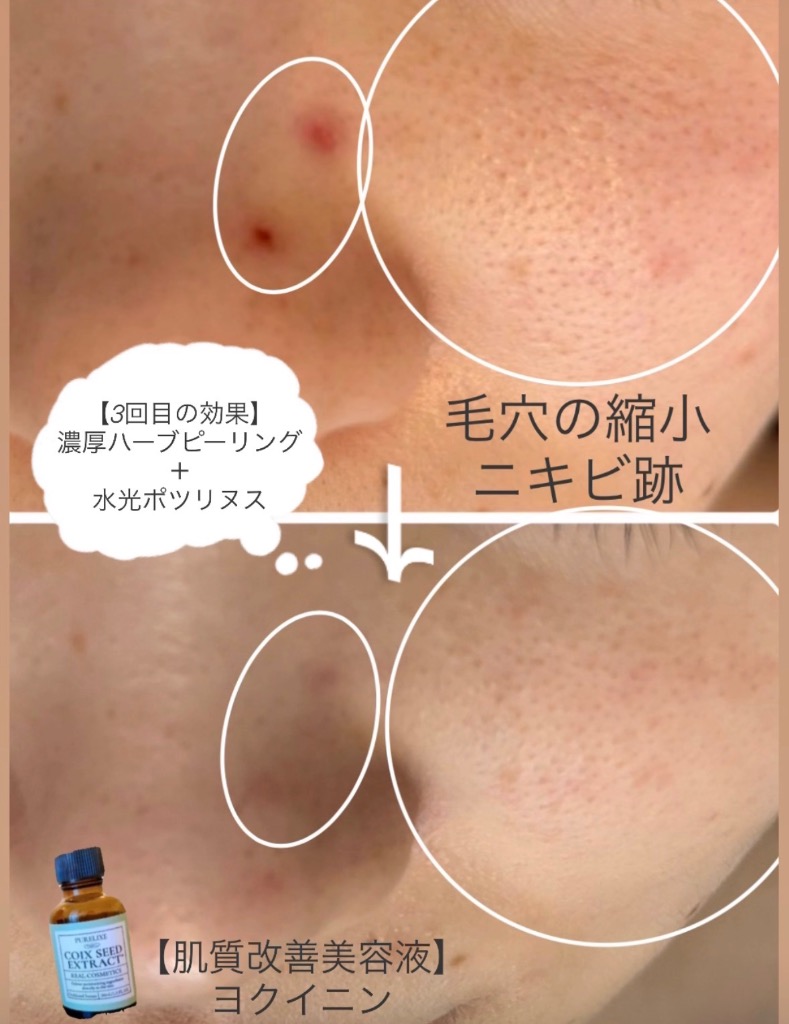 毛穴とニキビ同時に改善🤩