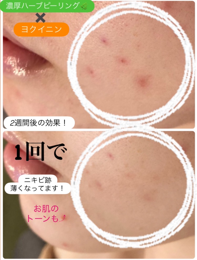 ニキビ跡も薄くなってます(^^)