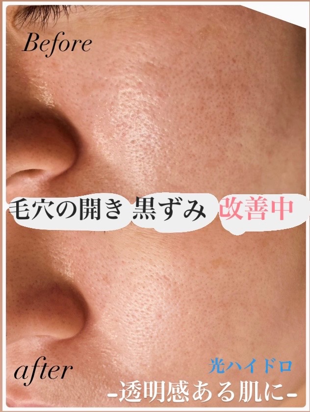 毛穴の開き/黒ずみ　改善中◎